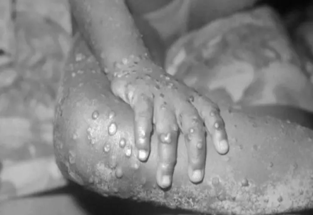 Două noi cazuri de variola maimuței depistate în România